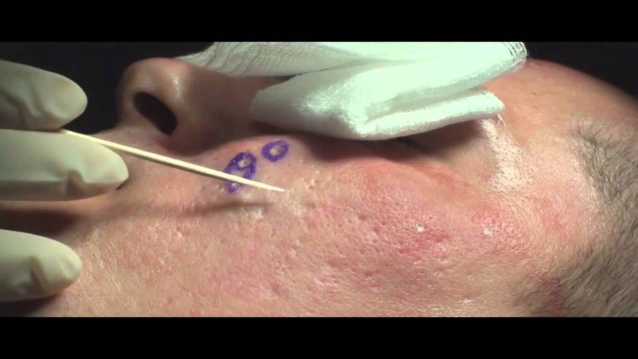 Meios contra um acne em adolescentes