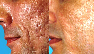 Laser CO2 Fracionado para Tratamento de Cicatriz de Acne