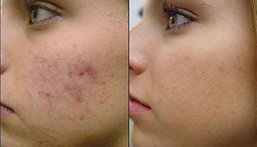 Luz intensa pulsada tratamento cicatriz de acne
