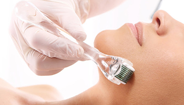 Microagulhamento para tratamento de cicatriz de acne