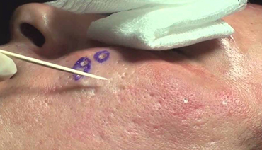 Peelings Químicos para tratamento de cicatriz de acne