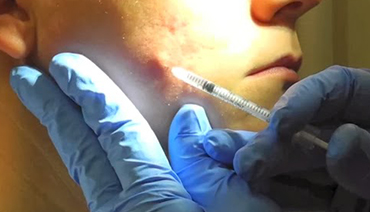 Preenchimento com Ácido Hialurônico tratamento Acne