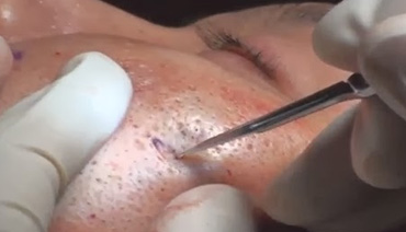 Subcisão para tratamento cicatriz de acne