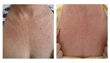 Skinbooster (hidratação injetável)