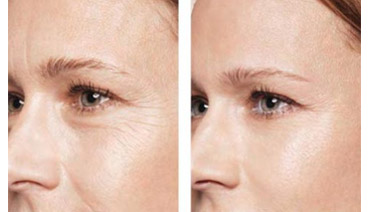 Skinbooster (hidratação injetável)