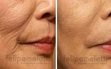 skinbooster-hidratacao-injetavel-felipe-meletti