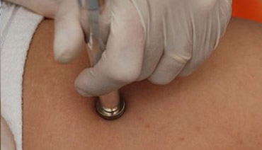 dermoabrasão tratamento estrias dermoabrasão tratamento estrias