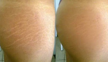 laser de co2 fracionado tratamento estrias laser de co2 fracionado tratamento estrias