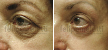 laser-de-co2-fracionado-para-tratamento-facial-clinica-felipe-meletti