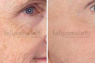 laser-de-co2-fracionado-para-tratamento-facial-felipe-meletti