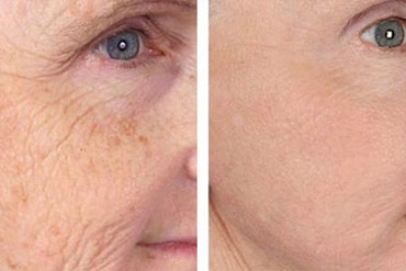 Laser de CO2 Fracionado tratamento facial antes e depois