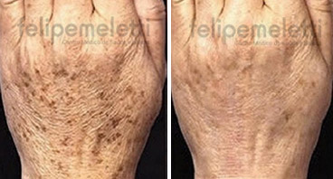 luz-intensa-pulsada-maos-e-braco-clinica-felipe-meletti