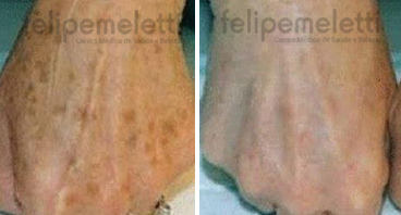 luz-intensa-pulsada-maos-felipe-meletti-