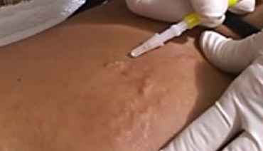 mesoterapia tratamento estrias