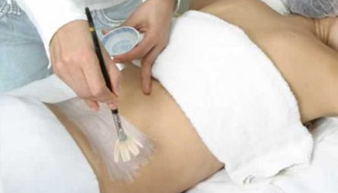 peeling químico tratamento estrias peeling químico tratamento estrias