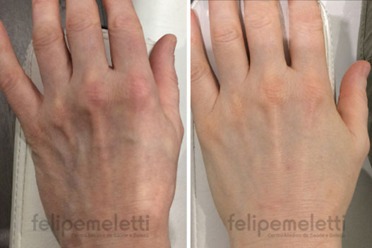 skinbooster-maos-clinica-felipe-meletti