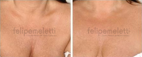 skinbooster-pescoco-colo-clinica-felipe-meletti