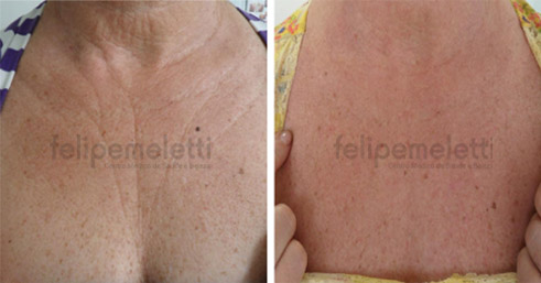skinbooster-pescoco-colo-felipe-meletti