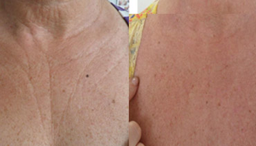 skinbooter pescoço colo