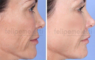 tratamento-facial-sculptra-clinica-felipe-meletti-