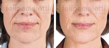 tratamento-facial-sculptra-felipe-meletti