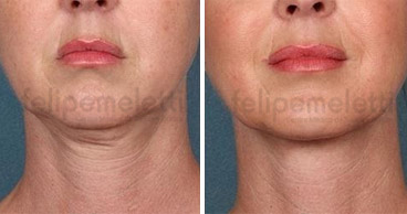 tratamento-sculptra-facial-clinica-felipe-meletti