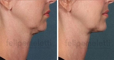 tratamento-sculptra-facial-felipe-meletti