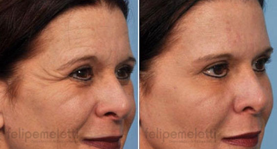 aplicacao-botox-rugas-felipe-meletti