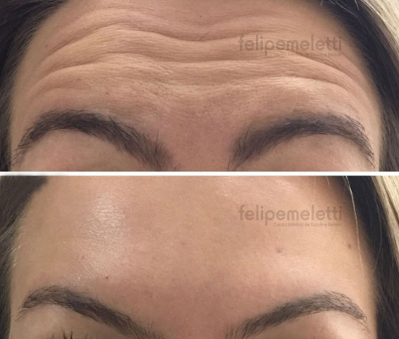 aplicacao-botox-testa-clinica-felipe-meletti