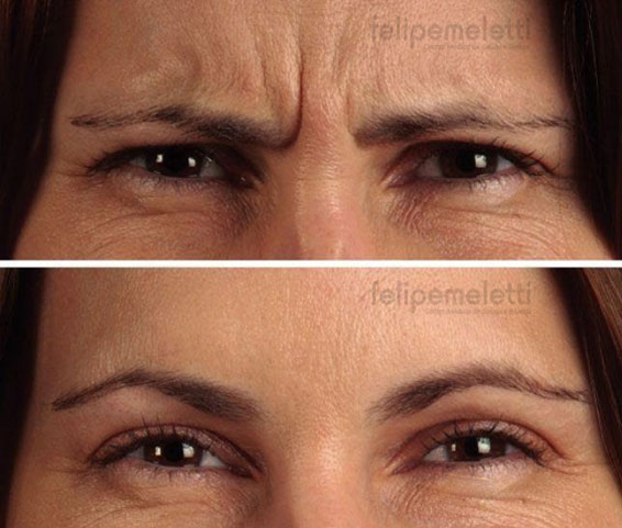 aplicacao-botox-testa--felipe-meletti