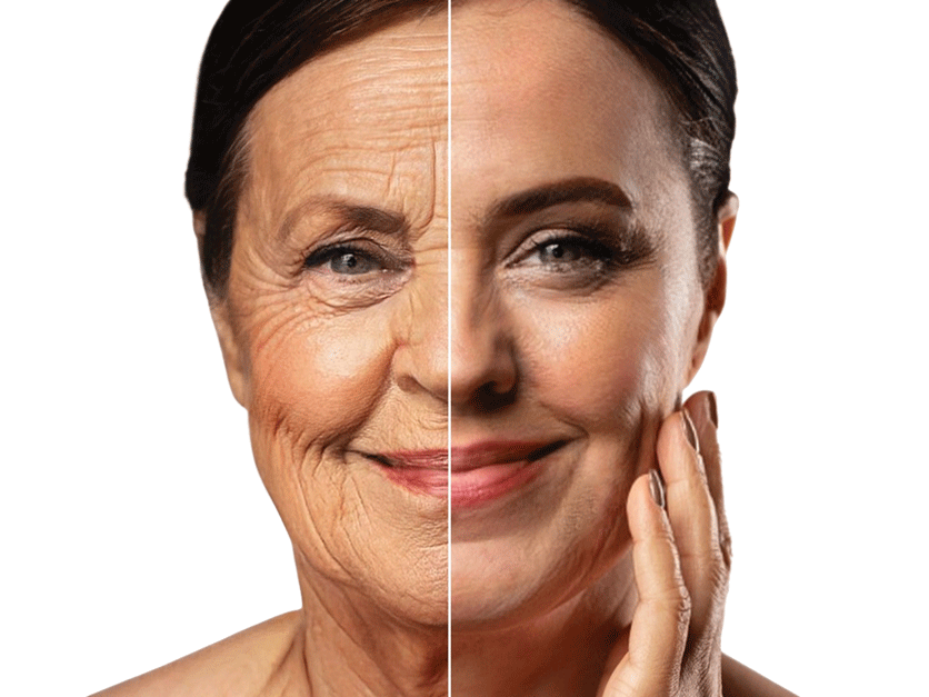 Peeling de Fenol Profundo - Clínica Felipe Meletti - Restart Facial Peeling de Fenol Profundo - Clínica Felipe Meletti - Restart Facial